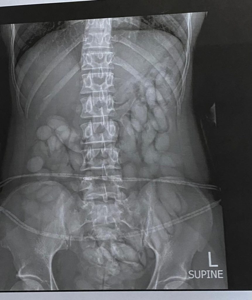 Picture19-861x1024 Namibian drug mule who swallowed bullets of suspected drugs arrested at OR Tambo International Airport